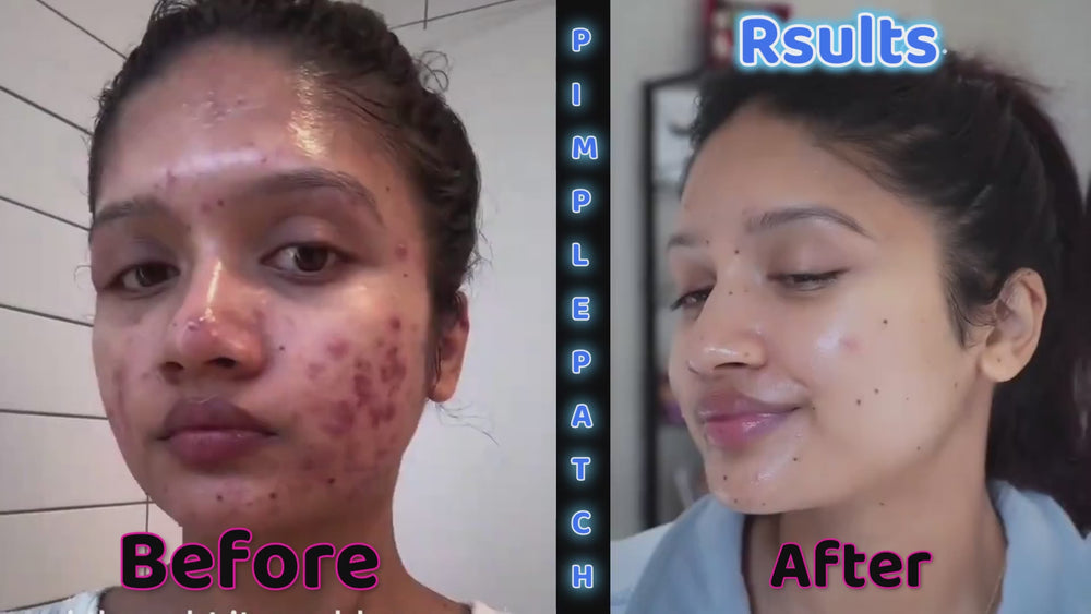 Imported Remove Acne Master Patch – 8-Hour Overnight